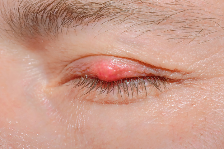 Infected Eye Lid (Eyelash mites)