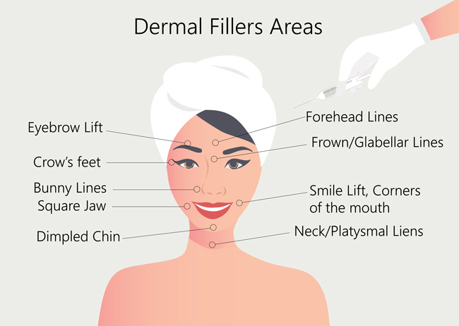 Uses of Dermal Fillers