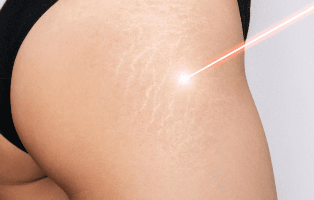 Microneedling and IPL to Erase Stretch Marks